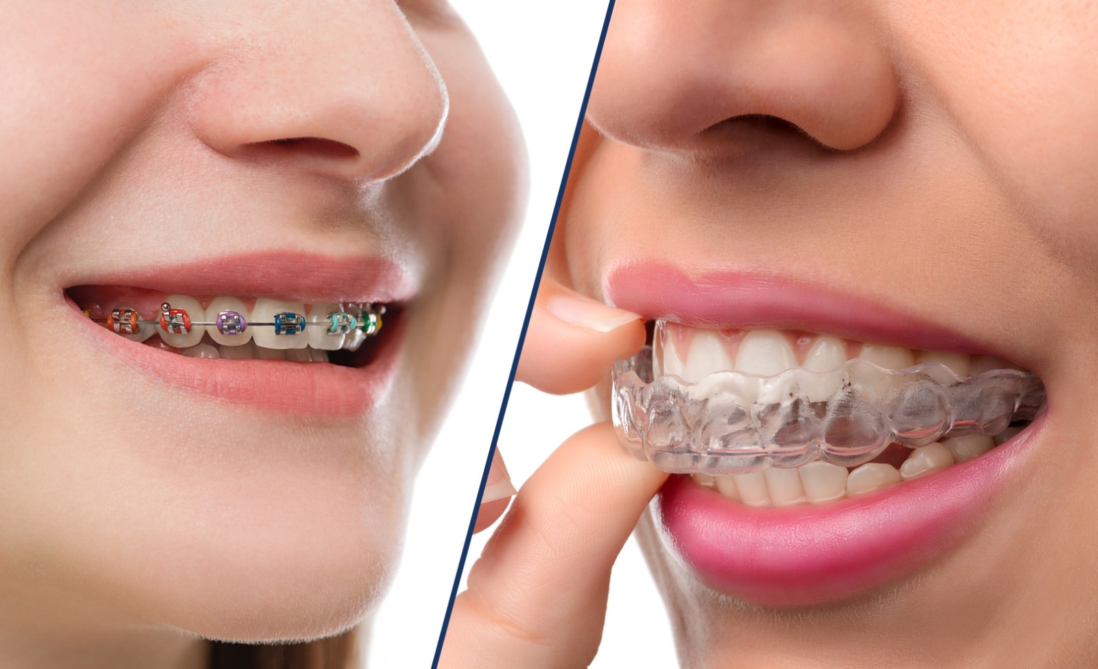 Braces vs. Transparent Aligners: Which Orthodontic Choice is Proper for You? – Your Scientific Prevent