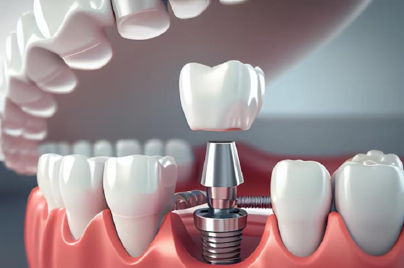 Overcoming Enamel Loss with Dental Implants: A Affected person’s Point of view – Your Scientific Forestall